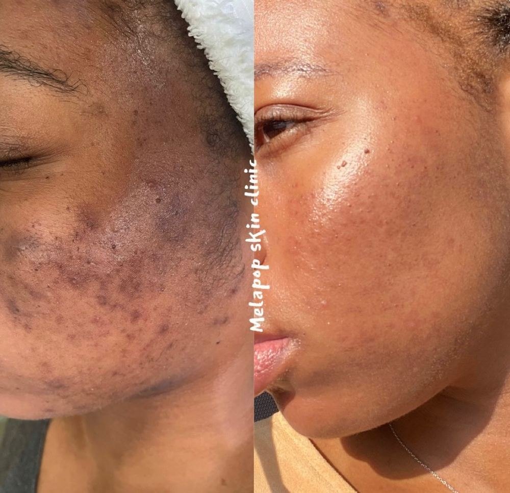 Post inflammatory hyperpigmentation before and after