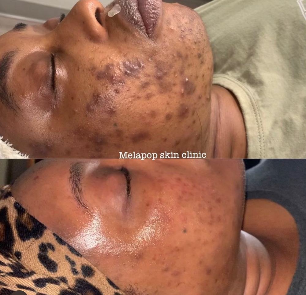 Post inflammatory hyperpigmentation before and after