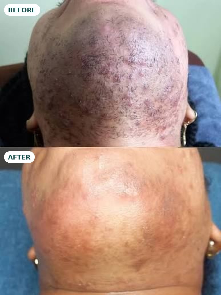 Post inflammatory hyperpigmentation on the chin before and after