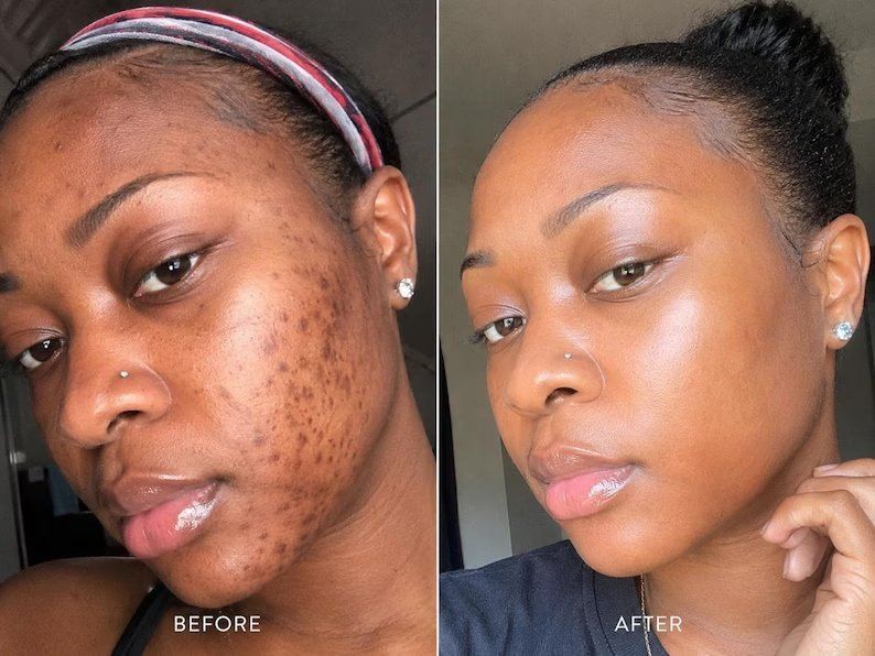 Post inflammatory hyperpigmentation before and after